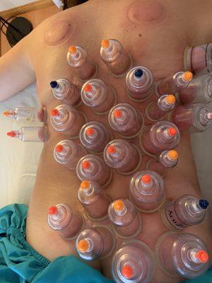 Cupping for pain