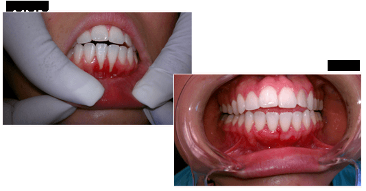 Gum Graft