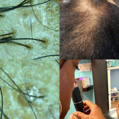 Hair Loss Consultation. Scaling the scalp for Alopecia type of hair loss