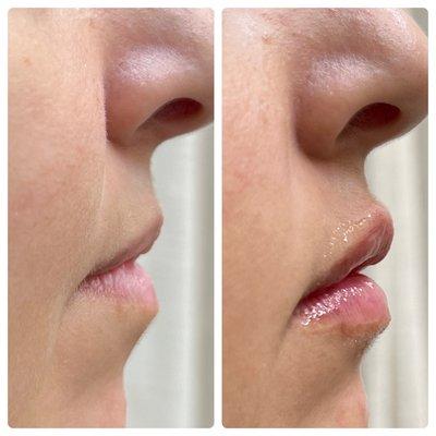 Before & After
Lip Augmentation