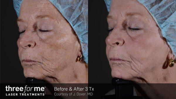 1540 Laser Resurfacing