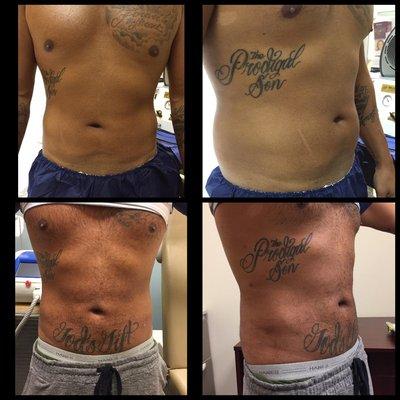 Lipo Before & After