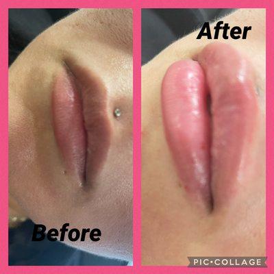 Lipfiller