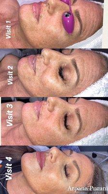 Level 1-3 correcting medical skin treatments