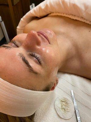 Dermaplaning