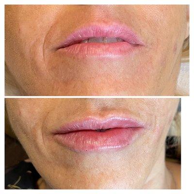 Service : Luscious Lips with Filler