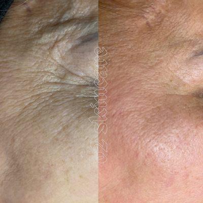 After one treatment using Procell technology.