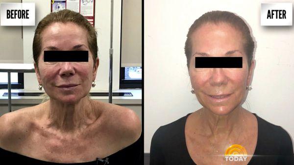 Skin rejuvenation of Kathy Lee    of the morning show. before & after. we offer the same service. affordable price the treatment celebrity