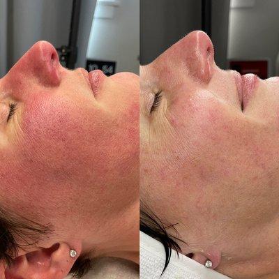 Treating sensitive skin- before and after only 1 enzyme