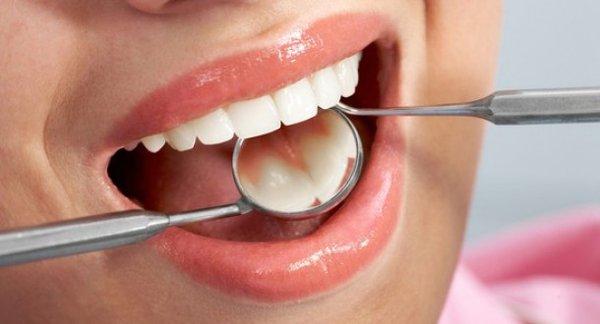 Dental Fillings