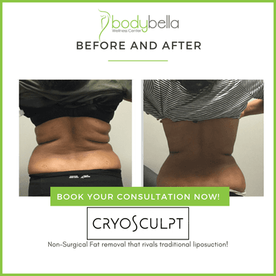 CryoSculpt before and after of Bra rolls.