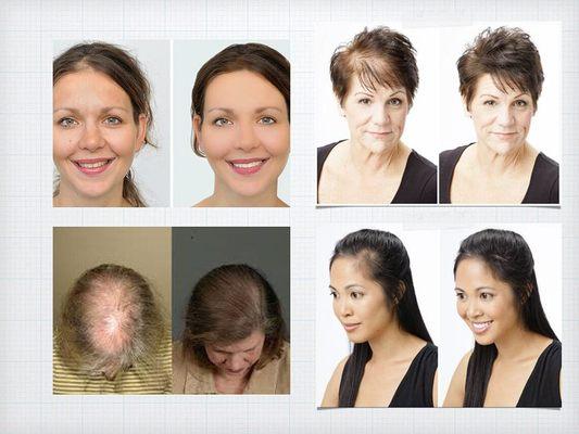 PRP Hair Loss Treatment Center