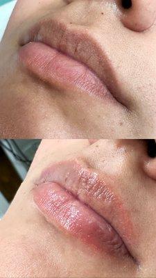 Lip hydration and exfoliation