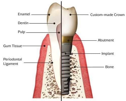 Dental Implant