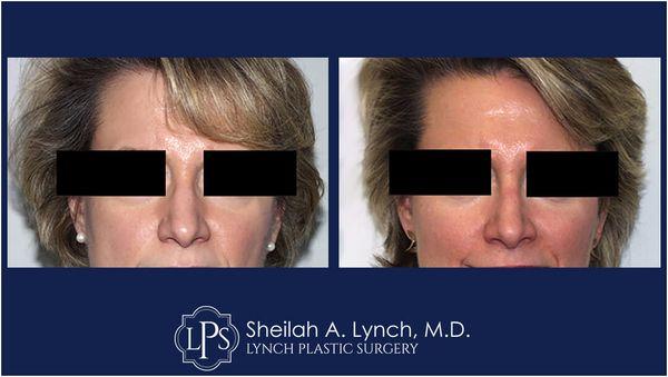 Nose ReshapingSurgery Before and After Patient (Rhinoplasty) Get an expert opinion   Board Certified Plastic Surgeon  Dr. Sheilah A. Lynch.