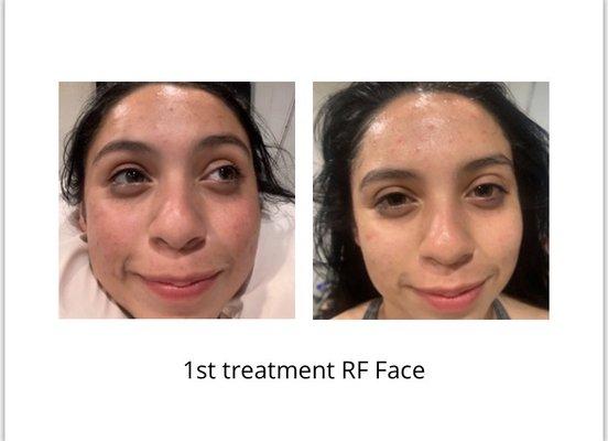 Radio frequency Face treatment