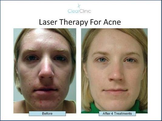 Laser Therapy for Acne