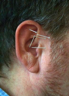 Auricular Therapy