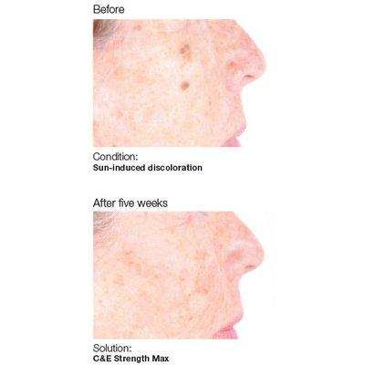 PCA Peels for Visible Aging and Hyperpigmentation