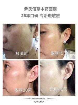 An effective treatment for skin pigmentation disorders.