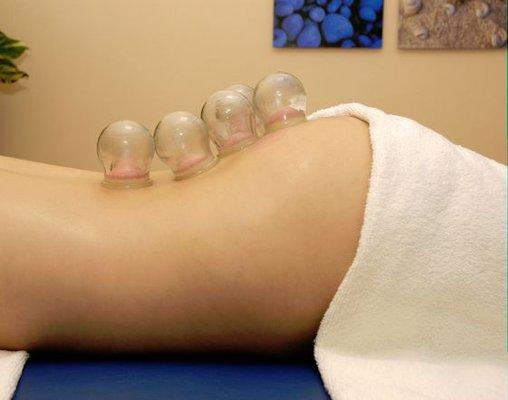 Cupping