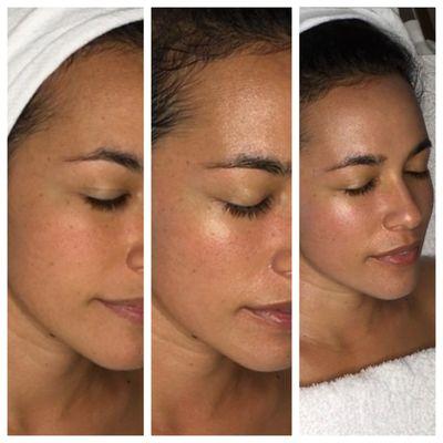 Vitamin A&C Facial,  before and after