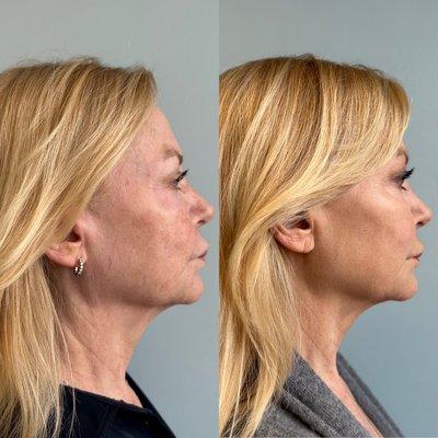 Dermal Filler to Chin, cheeks and jawline