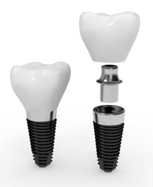 Pain less Dental Implants now offered at South Charlotte Dentist office on Pineville Matthews Road