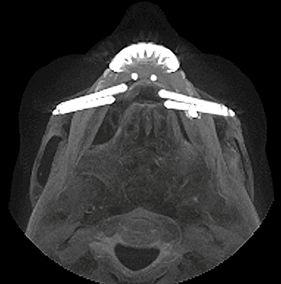 Oral Pathology Severna Park, MD