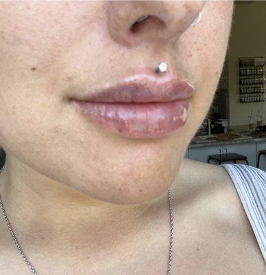 Lip Filler- about 1hr after: a little swelling & bruising, but that's normal. I love them!