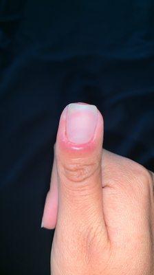 One of the nail technicians hurt my cuticle and it got infected. Its been like this for 2 weeks now