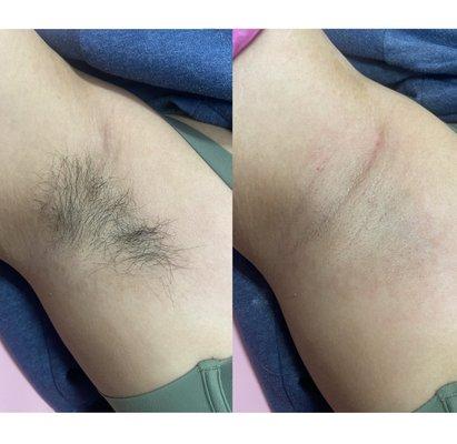 Underarm Wax Before and After