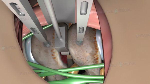 3D Informational Medical Animation