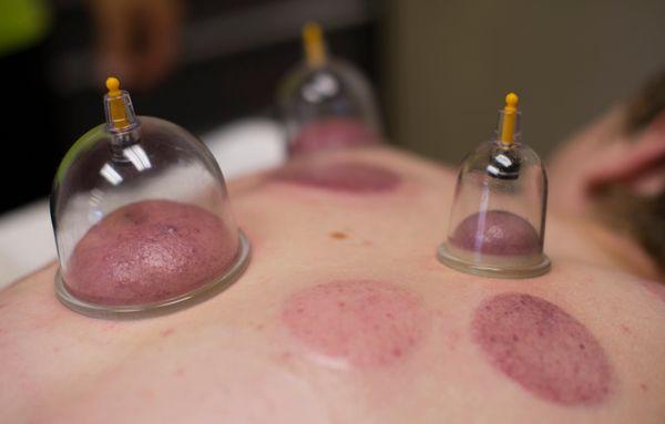 Cupping Therapy for the pain relief