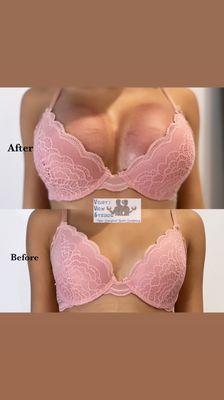 Non surgical breast lift using vacuum therapy