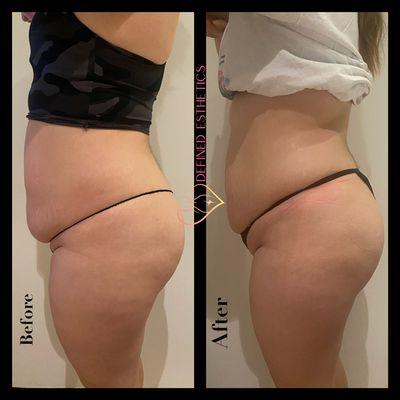 4 treatments of Lipo Cavitation, laser Lipo fat pads and radio frequency for skin tightening treatments performed.