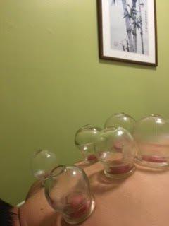 Cupping