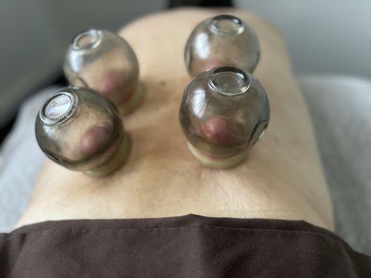 Cupping Therapy