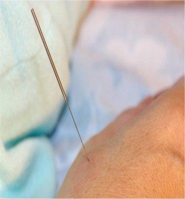 Acupuncture - Needle in