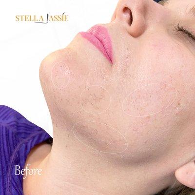 Stella Jassie Electrolysis Permanent Chin Hair Removal