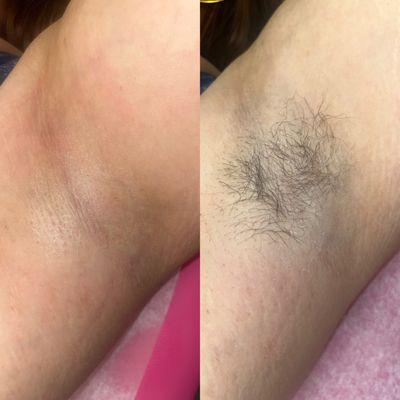 Underarm before & after