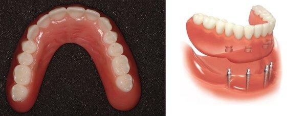 Mini Implants used to help stabilize a moving denture