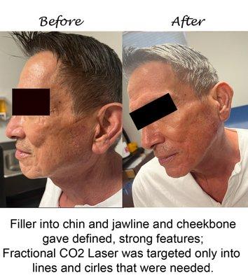 Laser beam set specifically to the shape of the scar/wrinkle so that no down-time was required; Cheek,chin,jawline filler must be balanced.