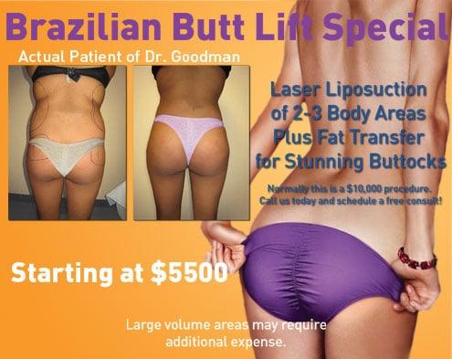 Smart Liposuction with fat transfer to the Buttocks by Florida's Top Expert