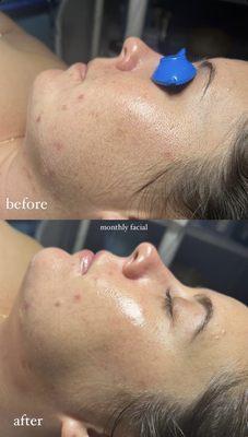 Acne facial