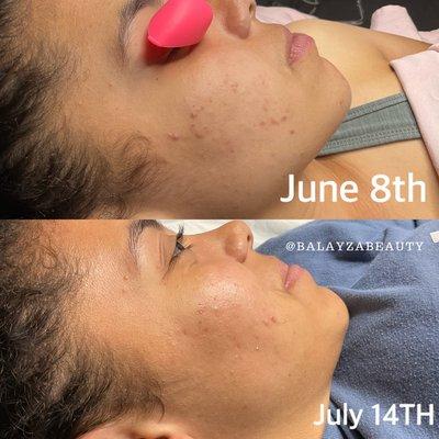 Before and After facial photos of a client!