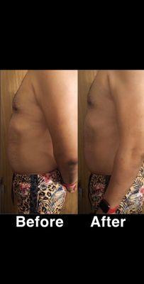 Laser-Lipo and cavitation