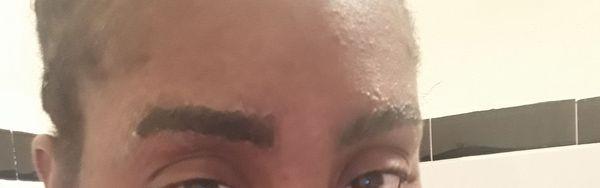 pic of my infected brows