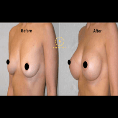 Breast Augmentation