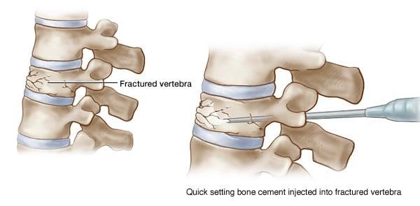 Spinal Compression Fractures